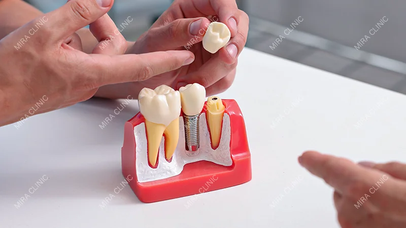 Dental Implants